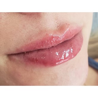 Preenchimento Labial com Ácido Hialurônico